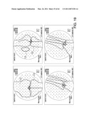 Total knee arthroplasty systems and processes diagram and image