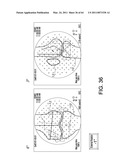 Total knee arthroplasty systems and processes diagram and image