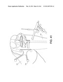 Total knee arthroplasty systems and processes diagram and image