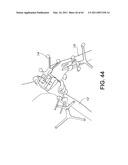 Total knee arthroplasty systems and processes diagram and image