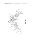 Total knee arthroplasty systems and processes diagram and image