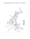 Total knee arthroplasty systems and processes diagram and image