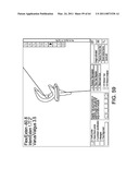 Total knee arthroplasty systems and processes diagram and image