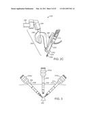 CURVED CANNULA diagram and image