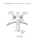 CURVED CANNULA diagram and image