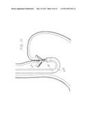 Surgical Clips Particularly Useful in the Endoluminal Treatment of Gastroesophageal Reflux Disease (GERD) diagram and image