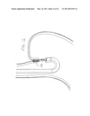 Surgical Clips Particularly Useful in the Endoluminal Treatment of Gastroesophageal Reflux Disease (GERD) diagram and image