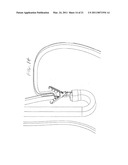 Surgical Clips Particularly Useful in the Endoluminal Treatment of Gastroesophageal Reflux Disease (GERD) diagram and image