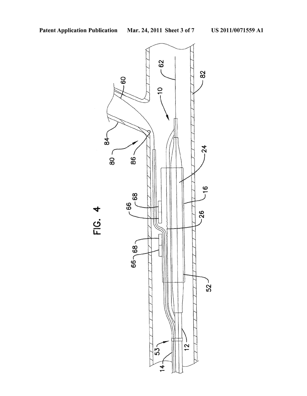 Cutting Member for Bifurcation Catheter Assembly - diagram, schematic, and image 04