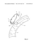 METHODS, DEVICES, KITS AND SYSTEMS FOR DEFUNCTIONALIZING THE CYSTIC DUCT diagram and image