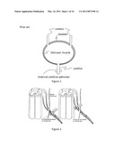 SACRAL NEUROSTIMULATION TO INDUCE MICTURITION IN PARAPLEGICS diagram and image