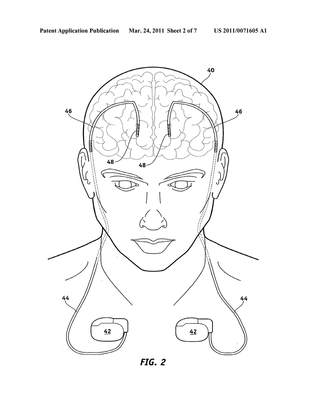 MRI-Safe Implantable Medical Device - diagram, schematic, and image 03