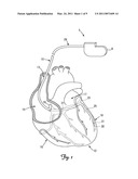 BIASING AND FIXATION FEATURES ON LEADS diagram and image