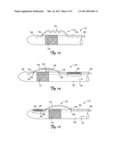 BIASING AND FIXATION FEATURES ON LEADS diagram and image