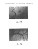 ANTI-ANGIOGENIC COMPOSITIONS AND METHODS OF USE diagram and image