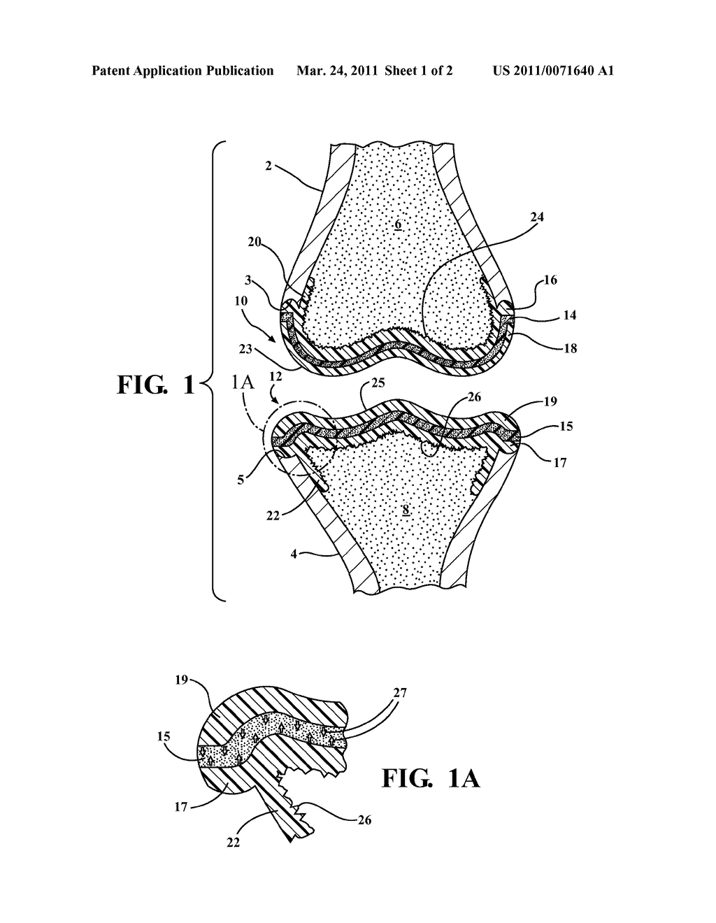 END SURFACE MOUNTED PLUGS INCORPORATED INTOAN ARTIFICIAL JOINT AND INCLUDING CUSHIONEDSOFT PLASTIC BETWEEN OUTER HARDENED PLASTICLAYERS TO IMPROVE WEAR CHARACTERISTICS - diagram, schematic, and image 02