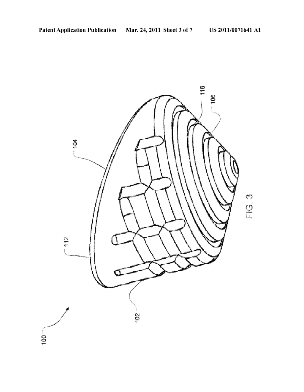 Articular Surface Implant and Delivery System - diagram, schematic, and image 04