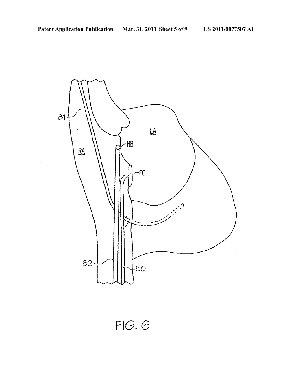 Method and apparatus for locating the fossa ovalis, creating a virtual fossa ovalis and performing transseptal puncture - diagram, schematic, and image 06