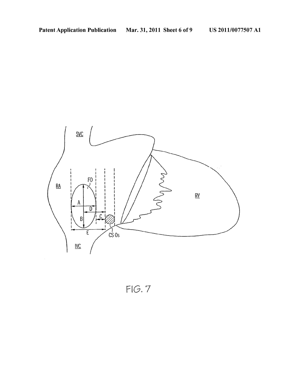 Method and apparatus for locating the fossa ovalis, creating a virtual fossa ovalis and performing transseptal puncture - diagram, schematic, and image 07