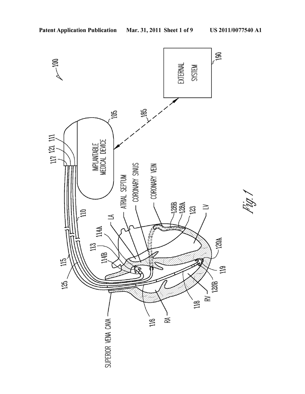 METHOD AND APPARATUS FOR DETECTING FIBRILLATION USING CARDIAC LOCAL IMPEDANCE - diagram, schematic, and image 02