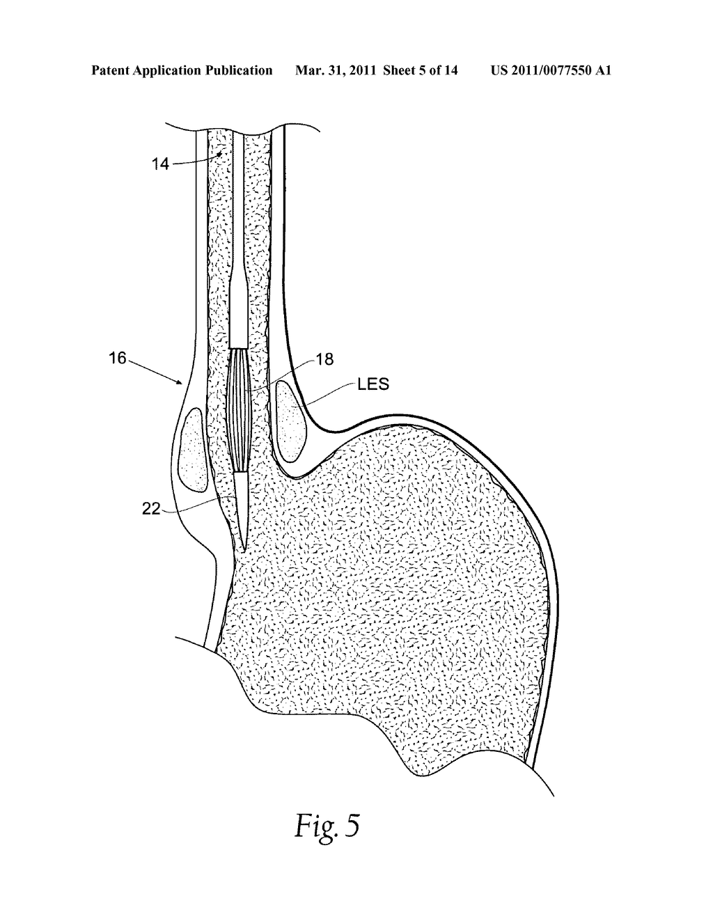 Systems and methods for treating tissue regions of the body - diagram, schematic, and image 06