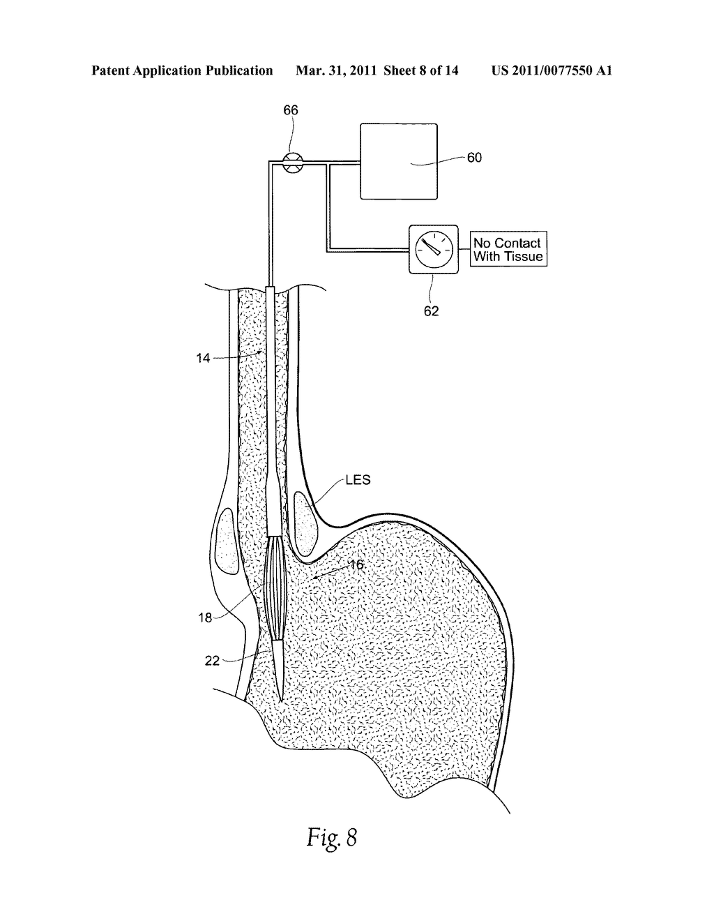 Systems and methods for treating tissue regions of the body - diagram, schematic, and image 09
