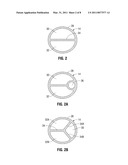 Medical Catheter Having a Design Providing Low Recirculation and Reversibility diagram and image