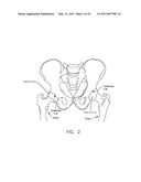 METHOD AND APPARATUS FOR MANAGING JOINT IRRIGATION DURING HIP ARTHROSCOPY diagram and image