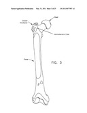 METHOD AND APPARATUS FOR MANAGING JOINT IRRIGATION DURING HIP ARTHROSCOPY diagram and image