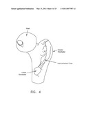 METHOD AND APPARATUS FOR MANAGING JOINT IRRIGATION DURING HIP ARTHROSCOPY diagram and image