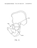 METHOD AND APPARATUS FOR MANAGING JOINT IRRIGATION DURING HIP ARTHROSCOPY diagram and image