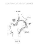 METHOD AND APPARATUS FOR MANAGING JOINT IRRIGATION DURING HIP ARTHROSCOPY diagram and image