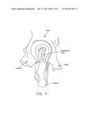 METHOD AND APPARATUS FOR MANAGING JOINT IRRIGATION DURING HIP ARTHROSCOPY diagram and image