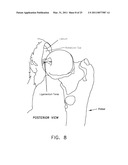 METHOD AND APPARATUS FOR MANAGING JOINT IRRIGATION DURING HIP ARTHROSCOPY diagram and image