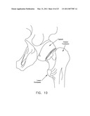 METHOD AND APPARATUS FOR MANAGING JOINT IRRIGATION DURING HIP ARTHROSCOPY diagram and image