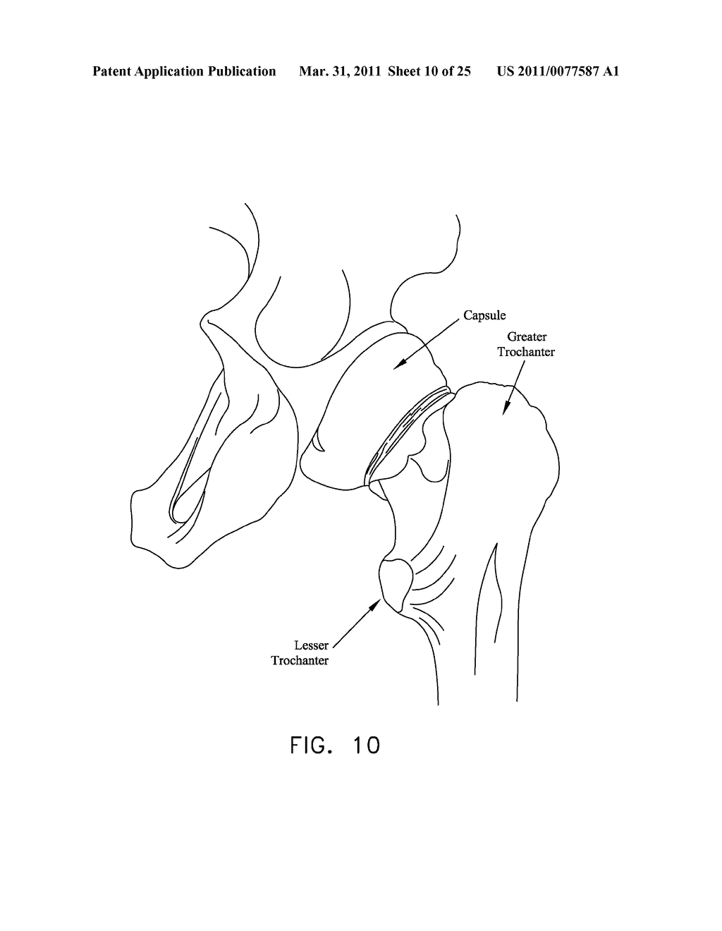 METHOD AND APPARATUS FOR MANAGING JOINT IRRIGATION DURING HIP ARTHROSCOPY - diagram, schematic, and image 11