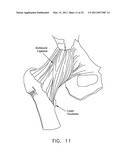 METHOD AND APPARATUS FOR MANAGING JOINT IRRIGATION DURING HIP ARTHROSCOPY diagram and image