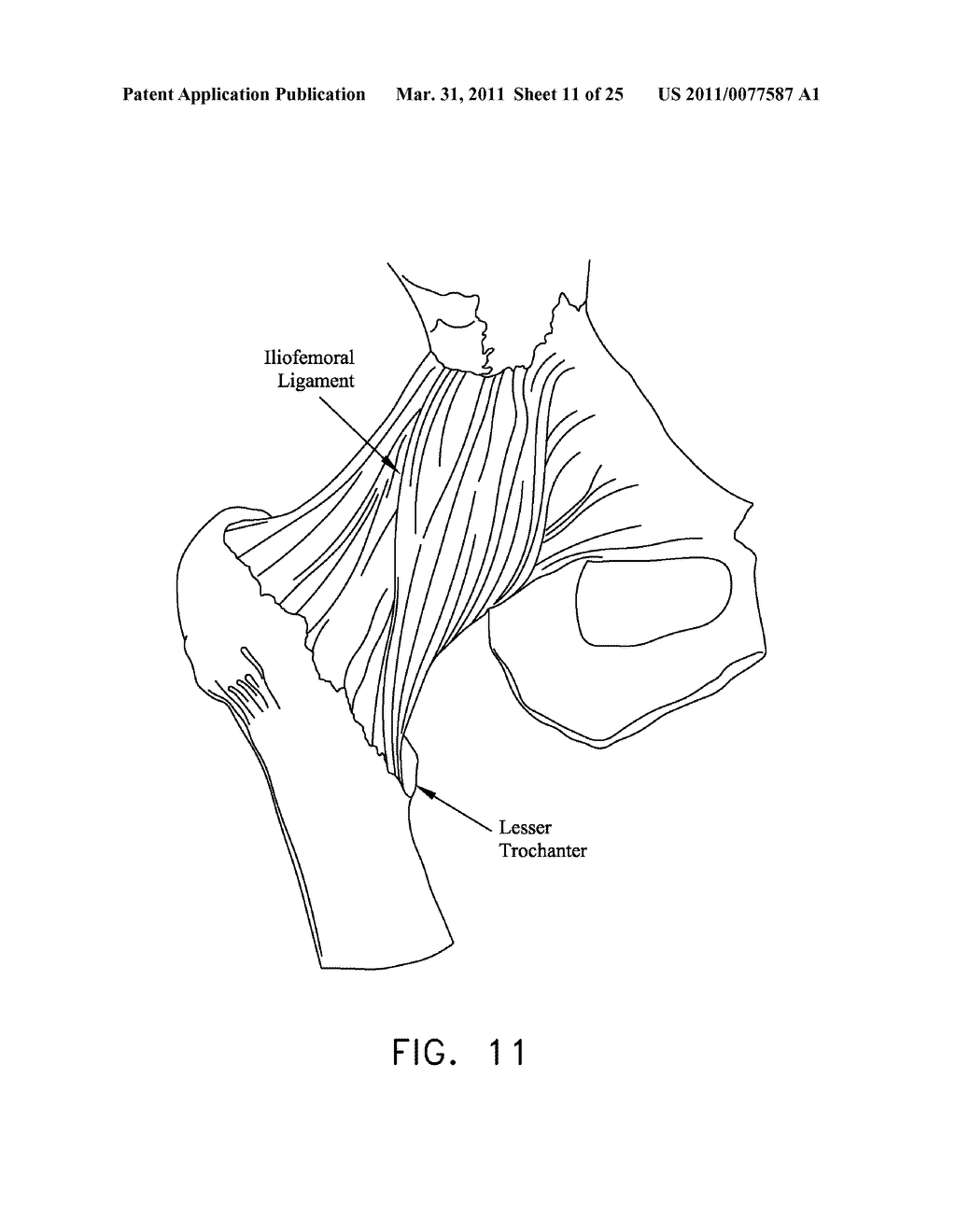 METHOD AND APPARATUS FOR MANAGING JOINT IRRIGATION DURING HIP ARTHROSCOPY - diagram, schematic, and image 12