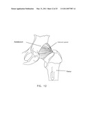 METHOD AND APPARATUS FOR MANAGING JOINT IRRIGATION DURING HIP ARTHROSCOPY diagram and image