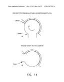 METHOD AND APPARATUS FOR MANAGING JOINT IRRIGATION DURING HIP ARTHROSCOPY diagram and image