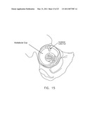 METHOD AND APPARATUS FOR MANAGING JOINT IRRIGATION DURING HIP ARTHROSCOPY diagram and image