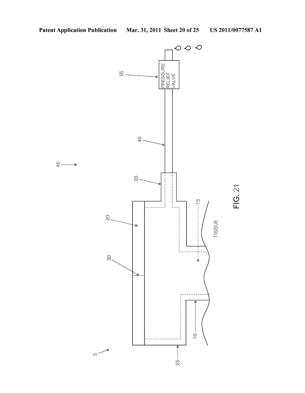 METHOD AND APPARATUS FOR MANAGING JOINT IRRIGATION DURING HIP ARTHROSCOPY - diagram, schematic, and image 21