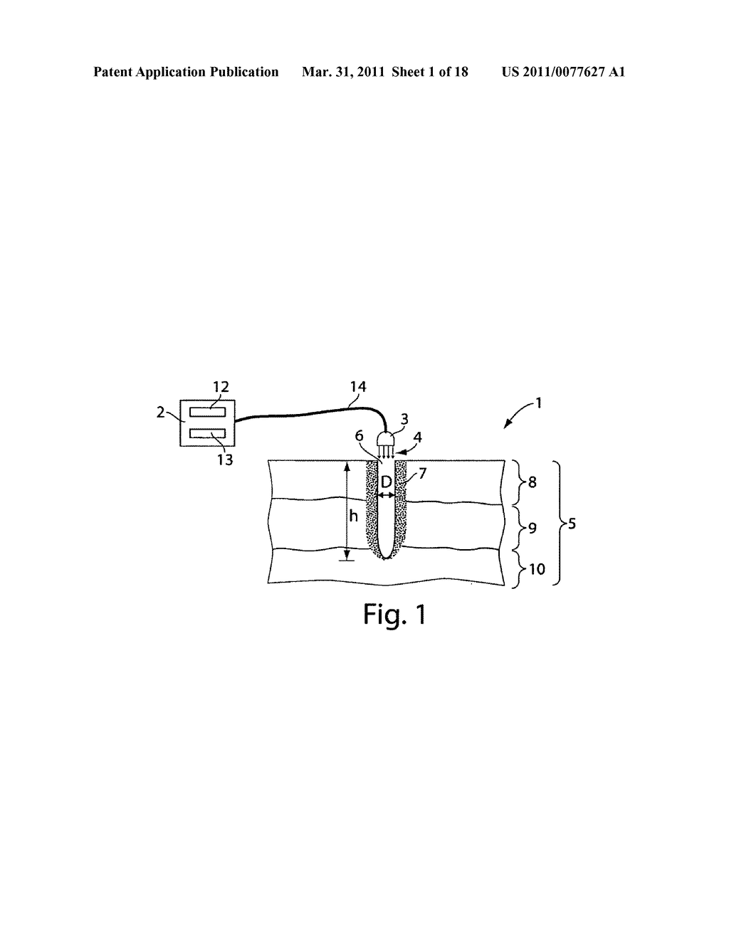 System and method for Microablation of tissue - diagram, schematic, and image 02