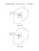 MEDICAL PROBE WITH TRANSLATABLE CO-ACCESS CANNULA diagram and image