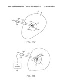 MEDICAL PROBE WITH TRANSLATABLE CO-ACCESS CANNULA diagram and image