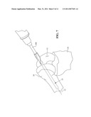 EXPANDABLE INTRAMEDULLARY ROD diagram and image