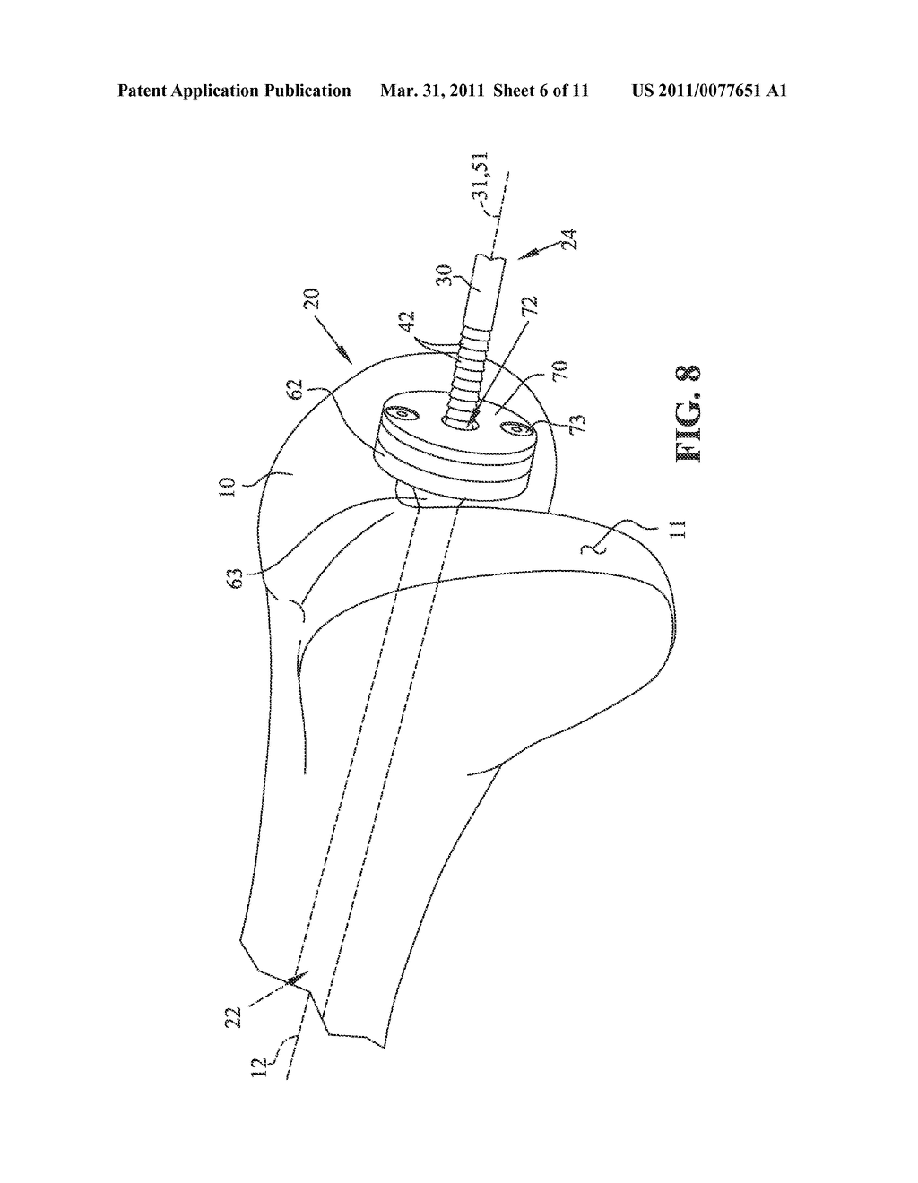 EXPANDABLE INTRAMEDULLARY ROD - diagram, schematic, and image 07