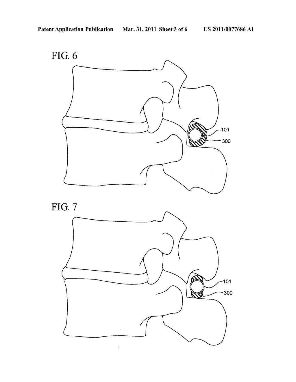 INTERSPINOUS PROCESS IMPLANT HAVING A COMPLIANT SPACER - diagram, schematic, and image 04