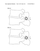 INTERSPINOUS PROCESS IMPLANT HAVING A COMPLIANT SPACER diagram and image