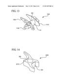 INTERSPINOUS PROCESS IMPLANT HAVING A COMPLIANT SPACER diagram and image